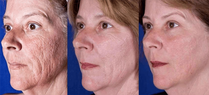 Result after laser face rejuvenation procedure