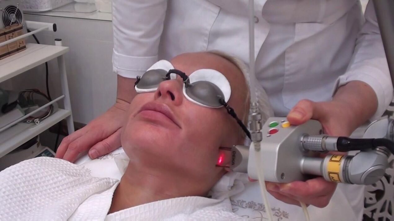 Treatment with a laser beam of problem areas in the facial skin